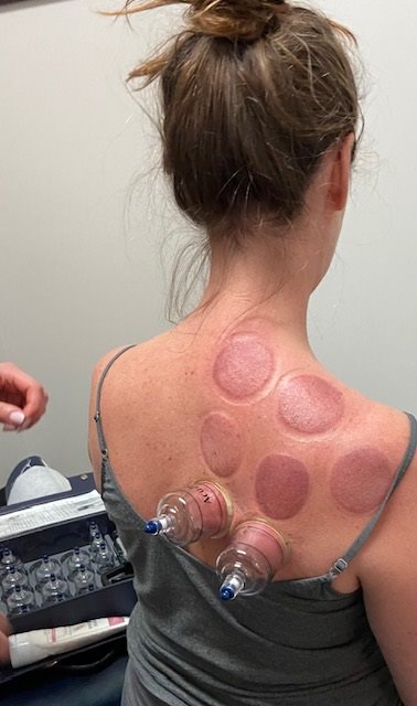 Chiropractic Evanston IL Cupping Patient