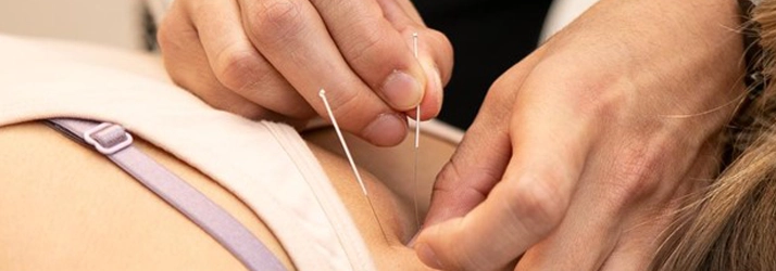 Chiropractic Evanston IL Dry Needling